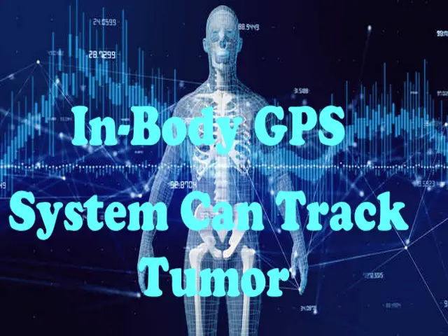 ‘In-body GPS’ System Can Track Tumor
